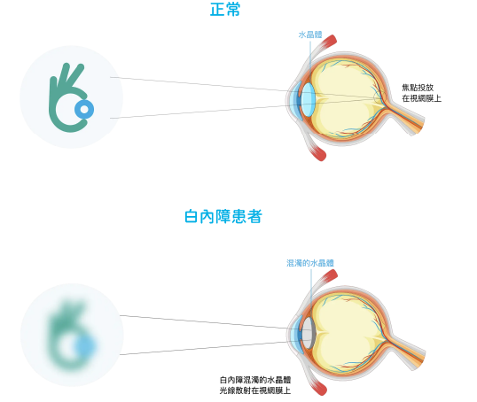 正常眼睛與白內障眼睛狀況比較