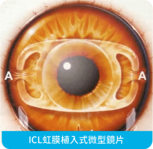 ICL虹膜植入式微型鏡片示意圖