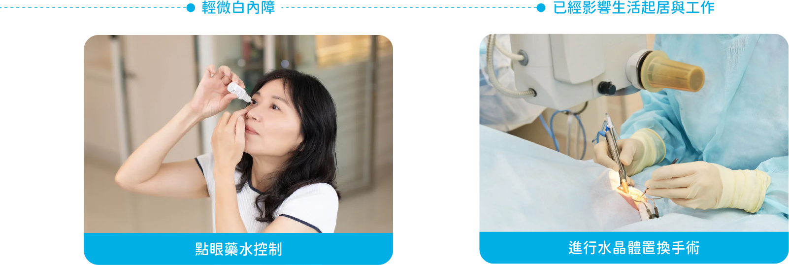 眼藥水控制或進行水晶體置換手術