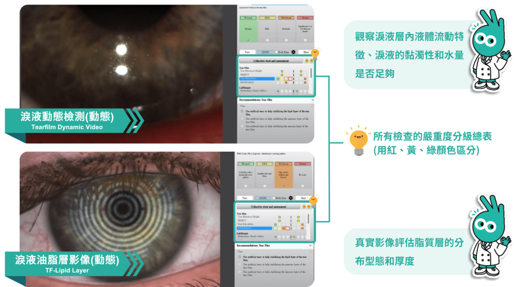 淚液動態檢測,淚液油脂層影像,醫學中心設備,賴麗如
