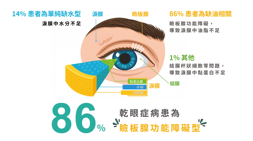 瞼板腺功能障礙,乾眼症,嘉義信賴眼科