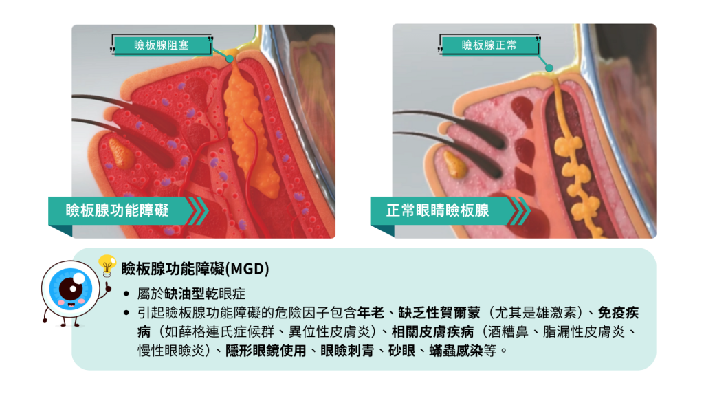 瞼板腺功能障礙,IPL,乾眼