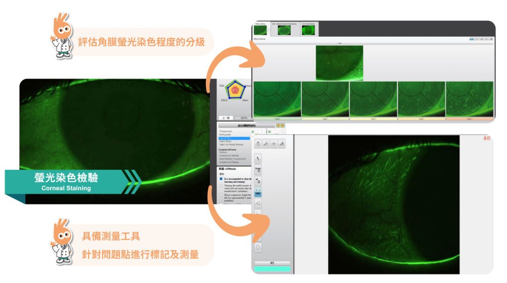 螢光染色檢驗,賴麗如,雲嘉南信賴眼科